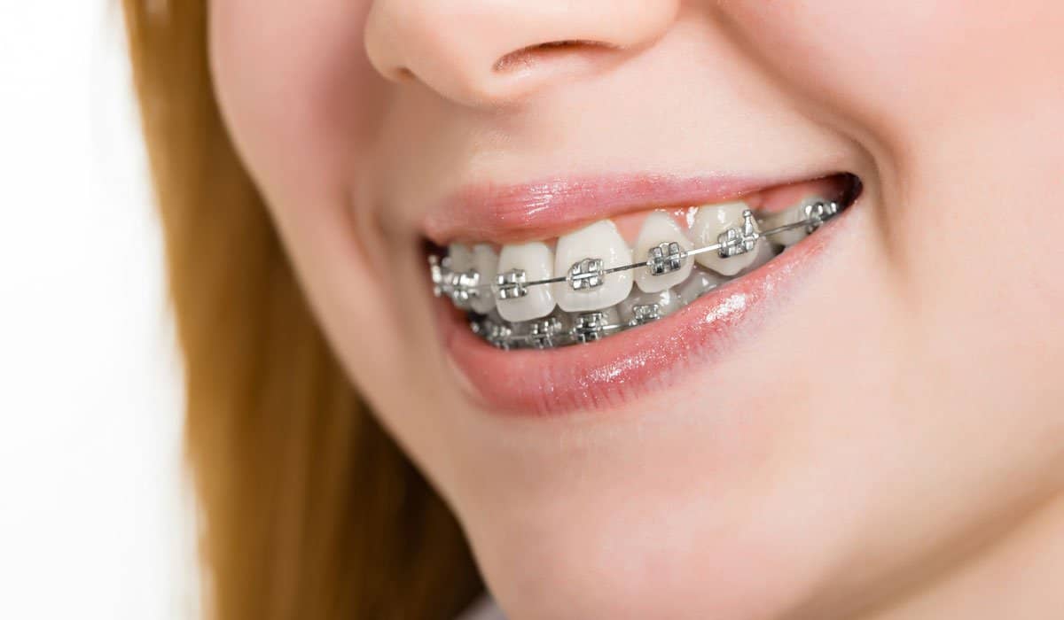 everything-you-need-to-know-about-braces-2.jpg