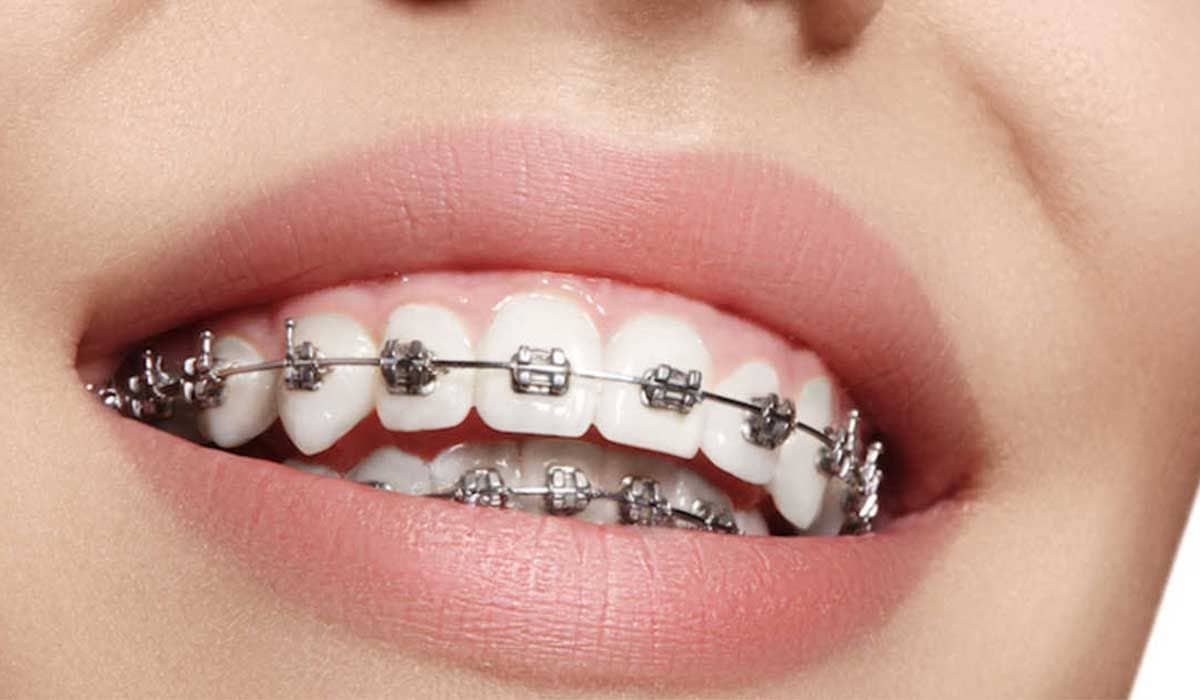 everything-you-need-to-know-about-braces.jpg