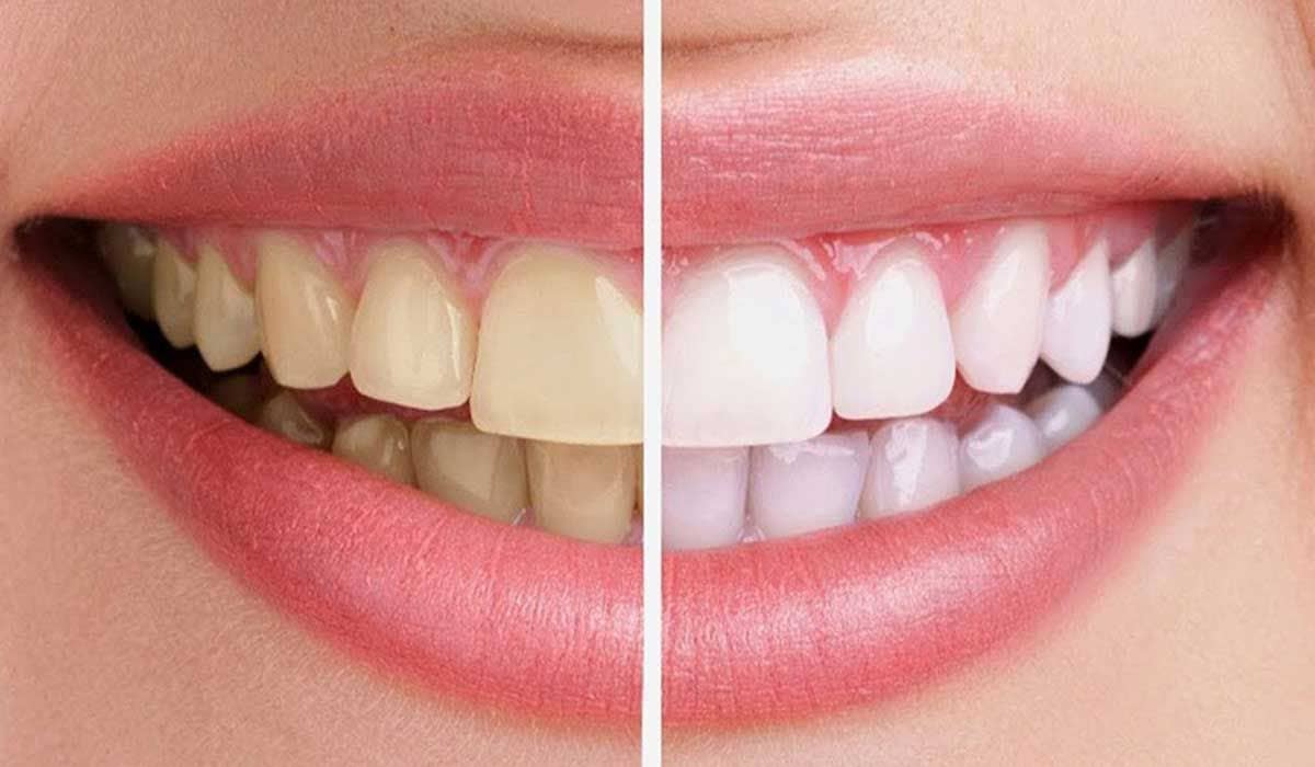 what-to-expect-before-a-teeth-whitening-procedure.jpg